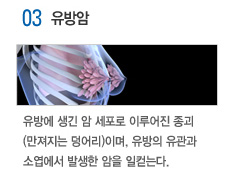 03 유방암 : 유방에 생긴 암 세포로 이루어진 종괴(만져지는 덩어리)이며, 유방의 유관과 소엽에서 발생한 암을 일컫는다.